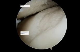 kind of astroscope on knee joint with osteoarthritis of the 3rd degree