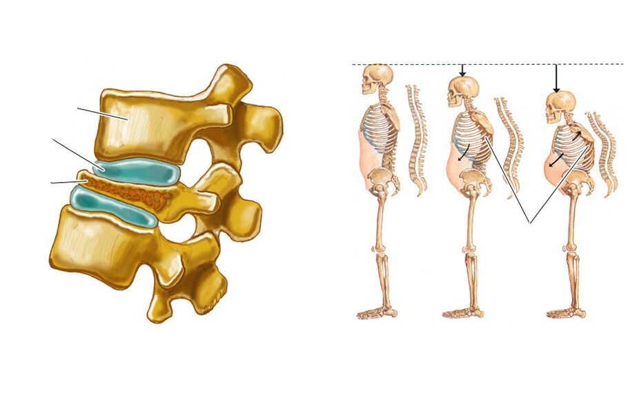 a flaccid spine leads to back pain