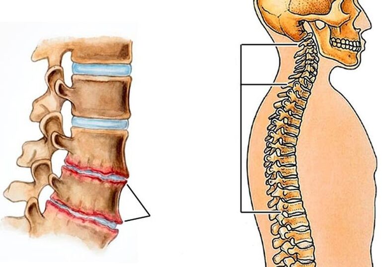 spinal curvature leads to back pain