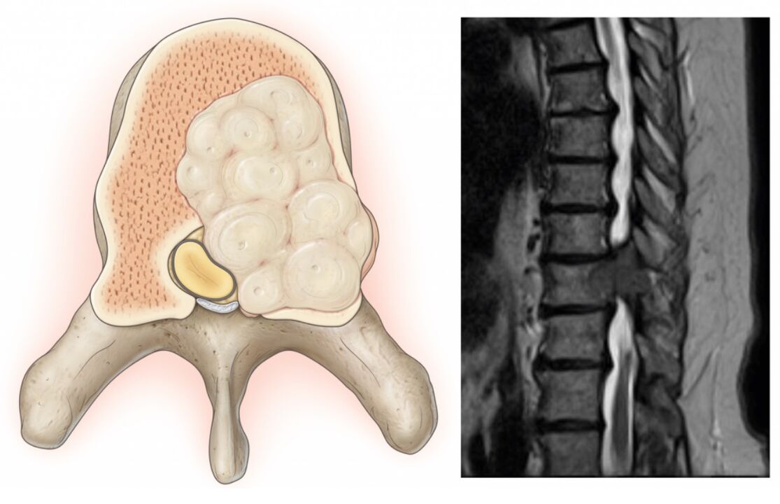 spinal swelling causes back pain