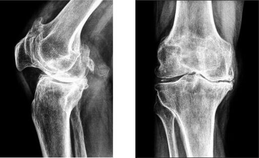 Knee gonarthrosis on x-ray