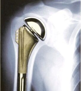 shoulder prostheses for osteoarthritis