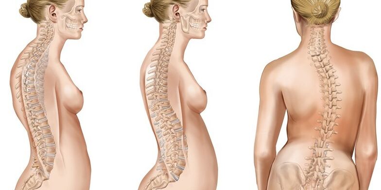 Thoracic spine scoliosis causes pain in the shoulder blades