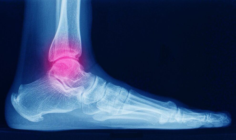 ankle osteoarthritis symptoms