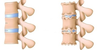 how to recognize the presence of lumbar spine osteochondrosis