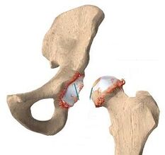 causes of arthrosis of the hip joint