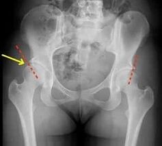 methods of treating osteoarthritis of the hip joint