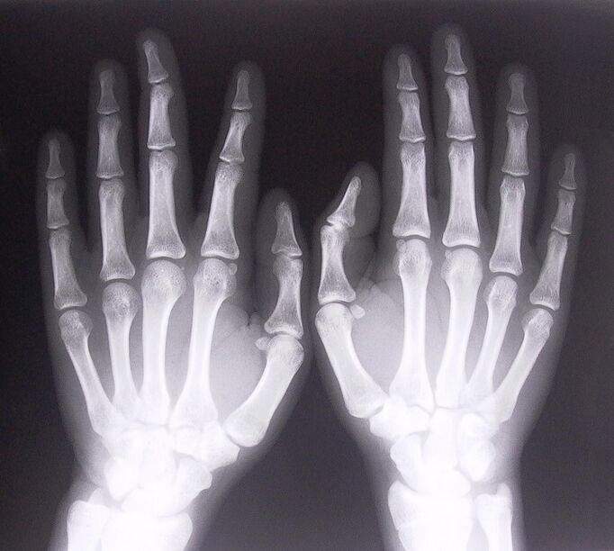 X-ray as a way to diagnose pain in the joints of the fingers